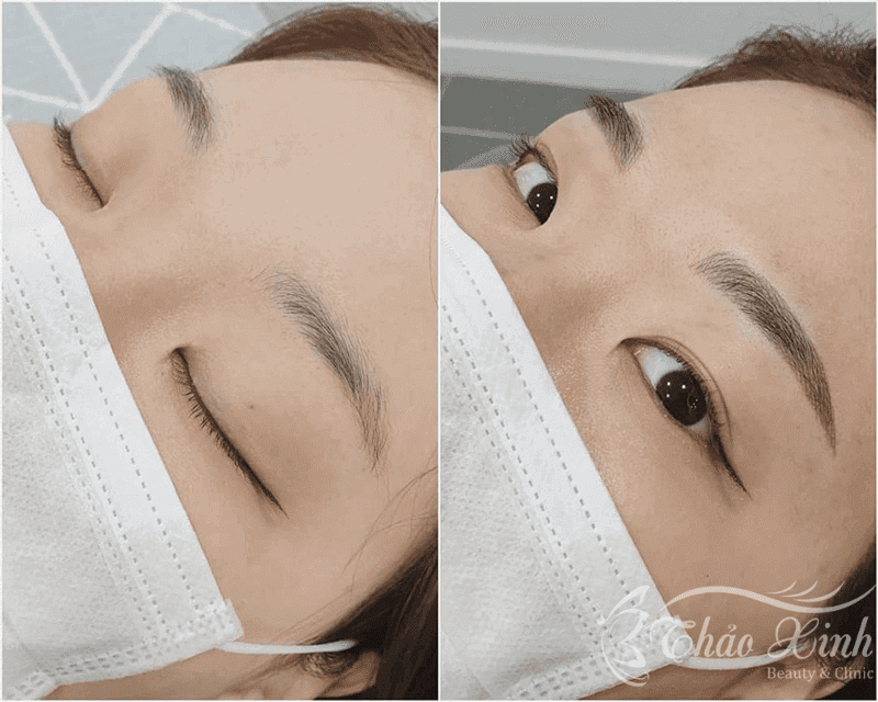 Ngứa lông mày sau khi điêu khắc